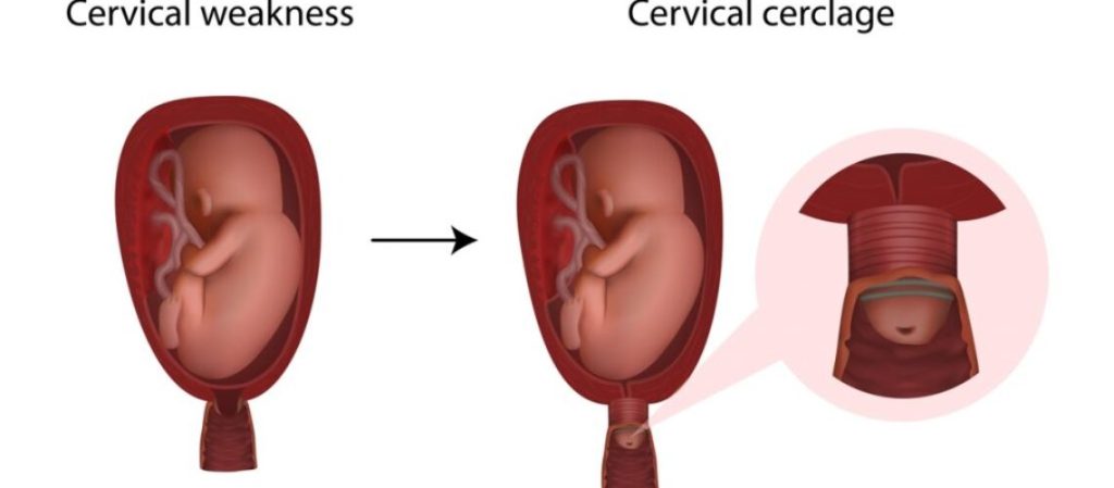 Cervical Cerclage