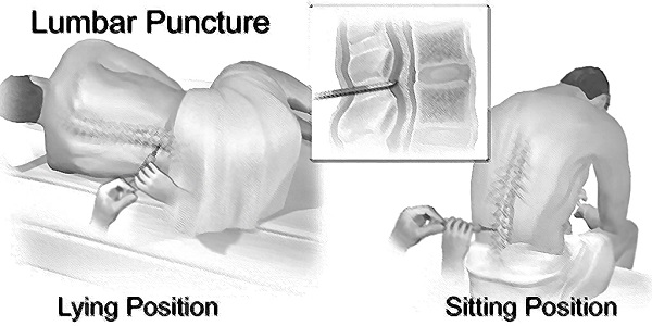 Lumbar Puncture