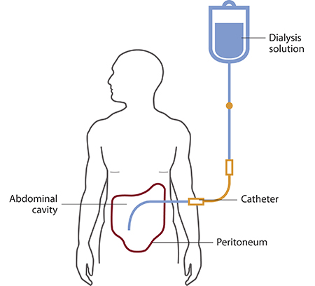 Dialysis
