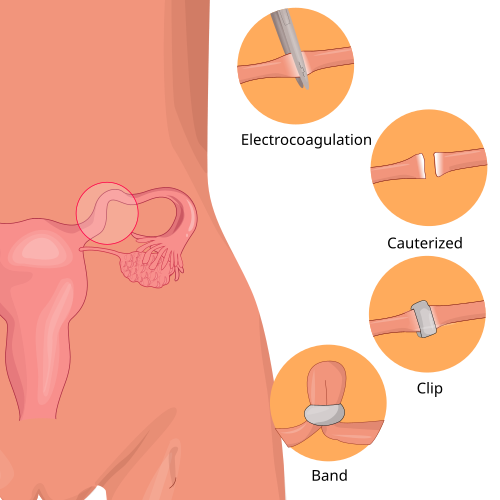 Tubal Ligation