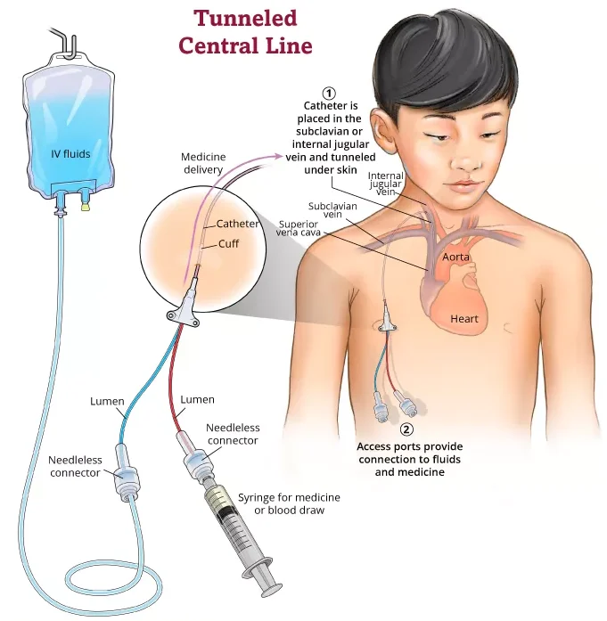 Central Line Insertion