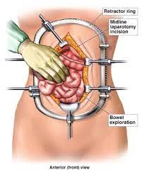 Laparotomy