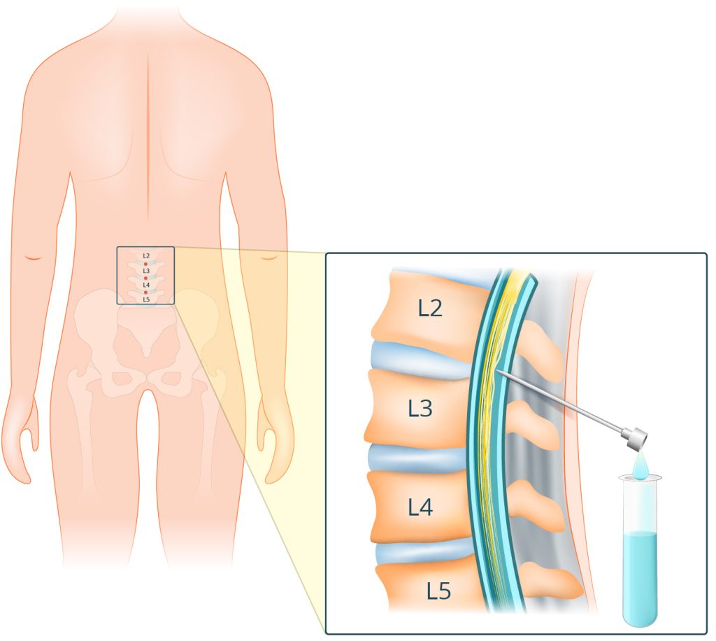 Lumbar Puncture