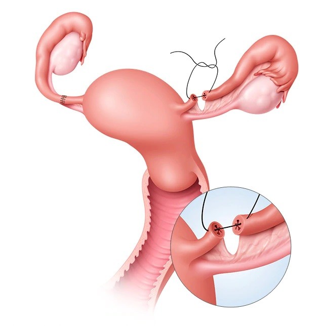 Tubal Ligation