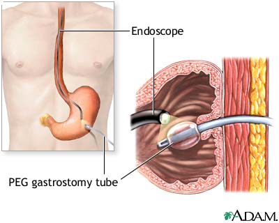 Percutaneous Endoscopic Gastrostomy (PEG Tube)