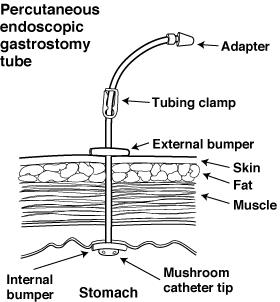 Percutaneous Endoscopic Gastrostomy (PEG Tube)