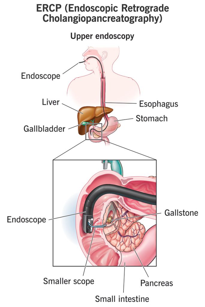 ERCP