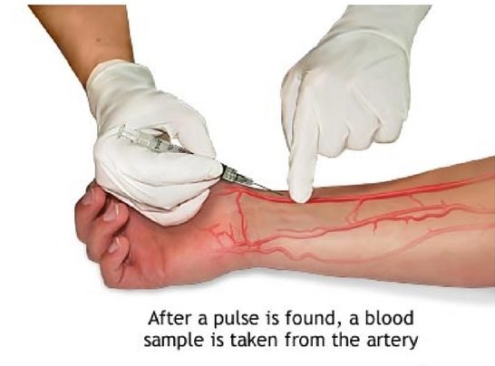 When is an ABG Test Performed? Doctors at Sarkar Hospital may order an ABG test in departments such as: Emergency Medicine Intensive Care Unit (ICU) Anesthesiology Pulmonology ABG tests help evaluate conditions such as: Acute respiratory failure Asthma attacks COPD exacerbations ARDS (Acute Respiratory Distress Syndrome) Sepsis and septic shock Diabetic ketoacidosis (DKA) Heart failure and cardiac arrest Severe infections and metabolic disorders Kidney-related acid imbalance It is also used to monitor treatment effectiveness in chronic lung or heart disease