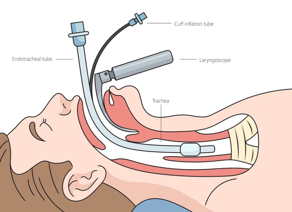 Intubation