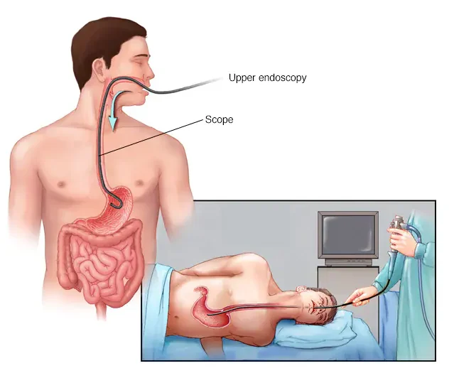 Upper GI Endoscopy